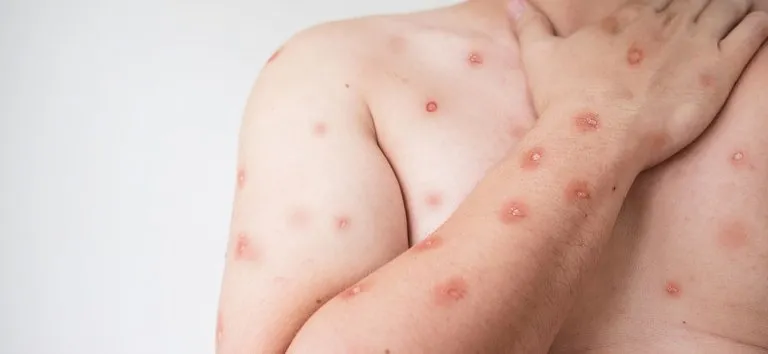 ALERTA EM GOIÁS: Mpox coloca saúde em estado de vigilância com casos suspeitos; veja como se proteger